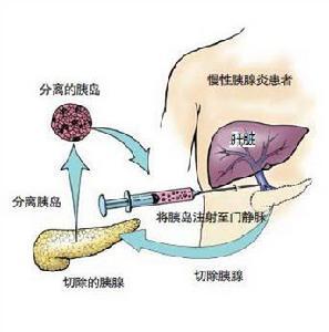 胰岛移植