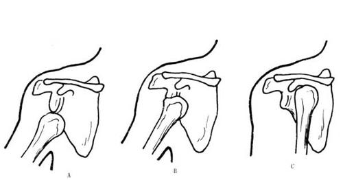 脱位x线正常肩关节x线复位后锚钉固定本文系吕宏升医生授权好大夫在线