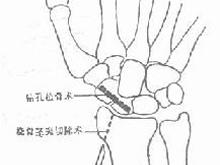 腕舟骨骨折如何预防