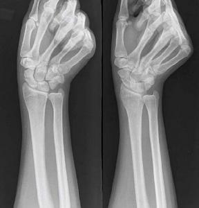 检查者一只手握住患者腕部,用拇指压迫舟骨结节,另一只手握住患者手掌