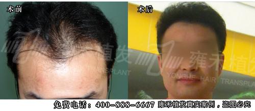 FUE-APL1.0无痕植发技术,意即高精密度移植术,由雍禾植发连锁机构自主创新,这项技术是在FUT/FUE技术基础上的完美升级,其最 大的特点是采用最精密的移植针在头发稀疏的部位,显微镜下做显微切口,避免损伤现有的毛囊单位,并且采用美国进口的无痕吻合缝合技术,将实现FUT和 FUE技术的密度和后枕部瘢痕的缺憾。