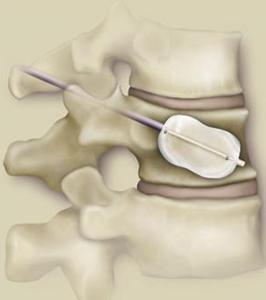 腰椎压缩性骨折+-+搜搜百科