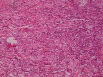 血管肉瘤-+搜狗百科