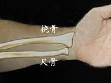 桡骨-尺骨茎突骨折