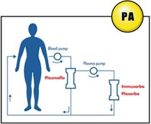 血浆置换