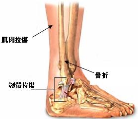 这两型骨折均可为单踝骨折,双踝骨折或三踝骨折(指内踝,外踝加胫骨