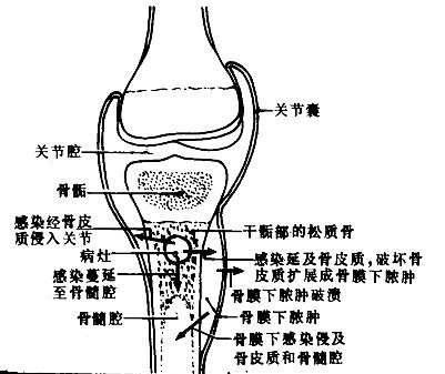 化脓性骨髓炎