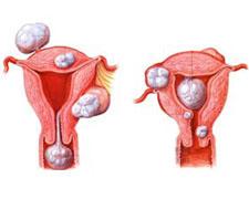 子宫肌瘤有良性和恶性之分,其中最常见的良性肿瘤为子宫平滑肌瘤,恶心
