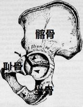 相关百科 髋臼骨折可由骨盆骨折时耻骨坐骨或髂骨骨折而波及髋臼,也可