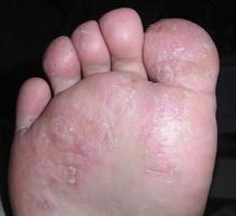 脚气是一种极常见的真菌感染性皮肤病,我国民间称之脚气或湿气脚气