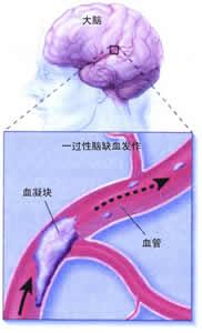 疾病防保之22:脑栓塞和脑梗塞