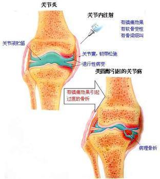 急性血源性骨髓炎是什么引起的