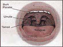 鼻咽,口咽,扁桃体慢性炎症刺激,导致悬雍垂发炎,使其肌肉组织变性