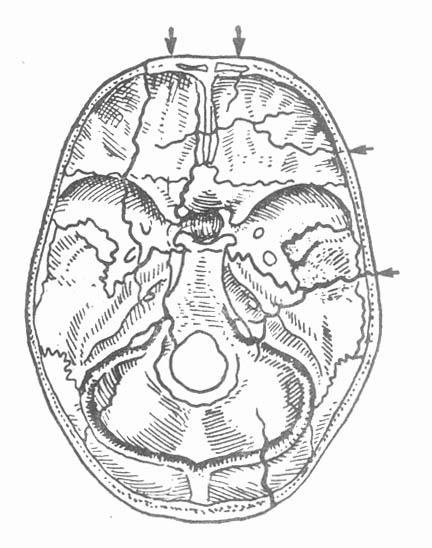 脑脊液漏图4-4 颅底骨折着力点与常见的骨折线位置; > 颅底骨折_颅底