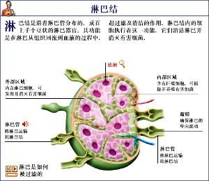 淋巴腺转移瘤