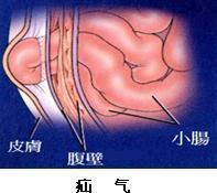 小儿疝气