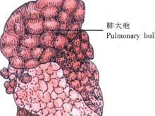 肺大疱是指发生在肺实质内直径超过1cm气肿性肺泡,常发生在肺气肿基础