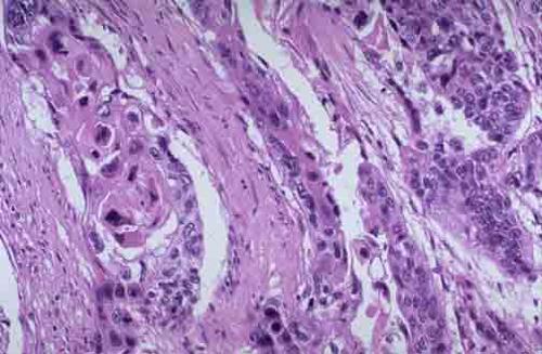 鳞状细胞癌亦称皮样癌,主要从有鳞状上皮覆盖的皮肤开始.