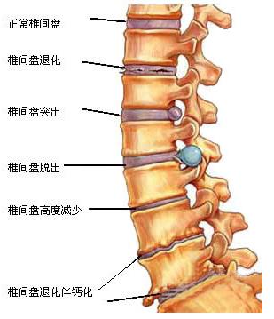 急性颈椎间盘突出症