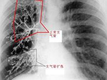 急性气管支气管炎