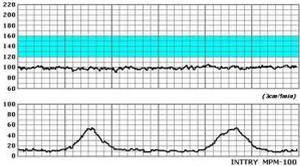 胎心监护+-+搜搜百科