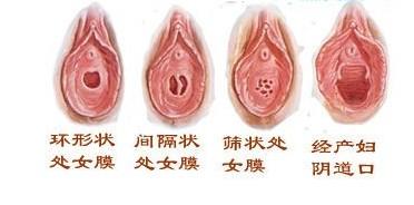 处女膜损伤较轻的只需要简单的修补便可完成