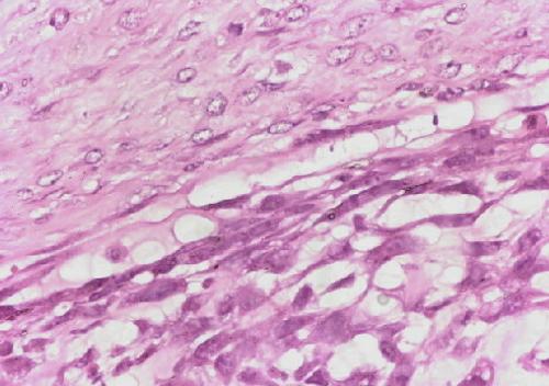 骨外软骨肉瘤+-+搜搜百科