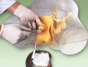 男性透明导尿模型