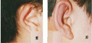 一般正常的耳朵和头侧是成30度角左右,而当角度大于45度时,在外观上便