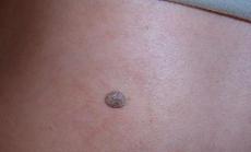 疣(wart)是人类乳头瘤病毒(hpv)所引起,是由病毒引起的一种皮肤表面赘