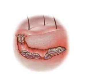 <em>疥疮</em>-+搜搜百科