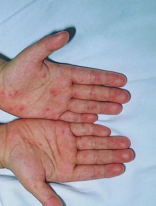  手足口病(hand foot and mouth disease hfmd)是一种常见及轻微