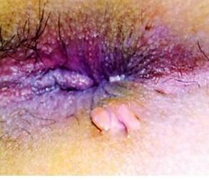 肛门出血+-+搜搜百科