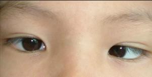 眼球内斜多表现为内斜视,内斜视俗称"斗鸡眼,是斜视中最常见的一种.