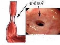 一般是指食管良性疾病(不含肿瘤)或并发症引起食管腔狭窄.