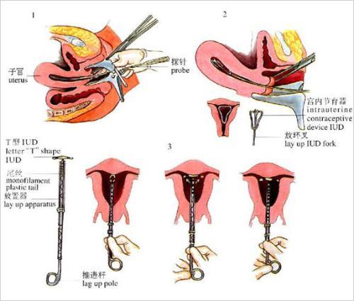 intra-uterine device (简称iud)),又称节育环,宫内节育器,医学专有词