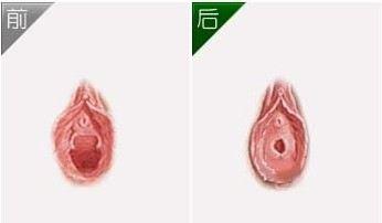 外阴整形术是指女性的外阴或泌尿生殖道因外伤