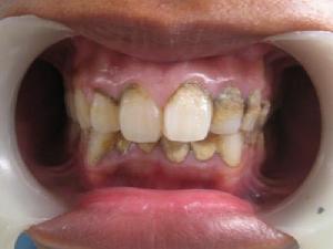 牙石根据其沉淀的部位,以龈缘为界,可以分为龈上牙石和龈下牙石(supra