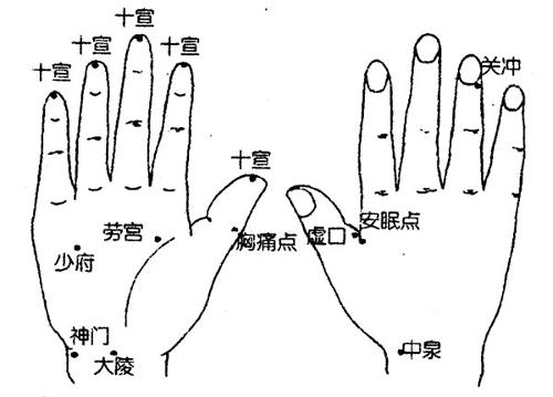 1 选穴十宣;患侧上肢肩俞,曲池,手三里,尺泽,合谷;患侧下肢风市,梁丘