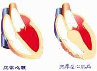 心脏左心室肥厚为主,主动脉不增宽,肺动脉段多无明显突出,肺淤血大多