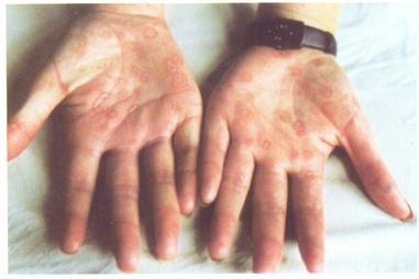 鳞屑斑; 二期梅毒图片;; 二期梅毒手掌部鳞屑斑