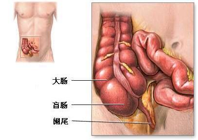 ⑤阑尾开口于盲肠部位的附近有病变,如炎症,息肉,结核,肿瘤等,使阑尾