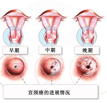 可被碘液染为棕色,而宫颈管柱状上皮,宫颈糜烂及异常鳞状上皮区(包括