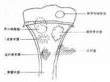 好发部位是长管状骨的干骺端,股骨远端和胫骨近端最多见,其次是肱骨和