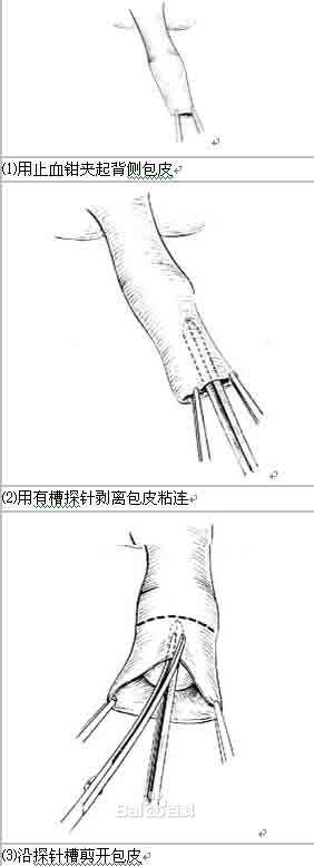 清洗消毒 用肥皂水和盐水清洗局部,用1:1000新洁尔灭液消毒;包茎者以