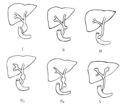 注:Ⅰ型.胆总管囊肿;Ⅱ型.