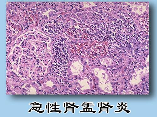 肾盂肾炎