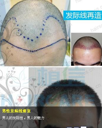 <em>发际线</em>修复