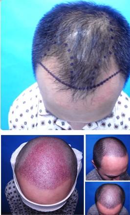 还有人的<em>发际线</em>呈<em>m型</em>