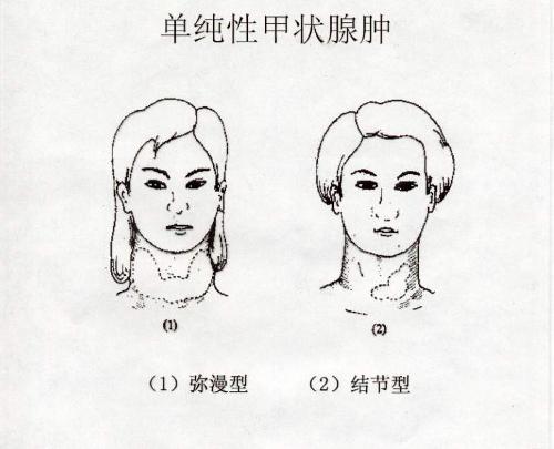 单纯性甲状腺肿